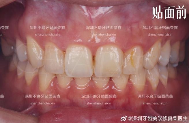 矫正时牙齿变色，到底是什么原因导致的？-图1