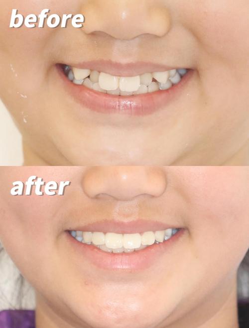 矫正时牙齿变色，到底是什么原因导致的？-图3