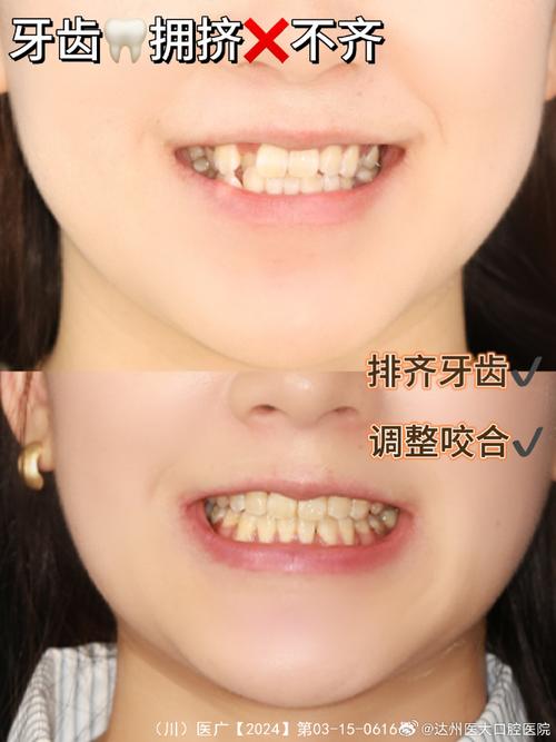 矫正中牙齿不齐?是正常现象还是需调整?-图2 矫正中牙齿不齐?是正常现象还是需调整?-图2