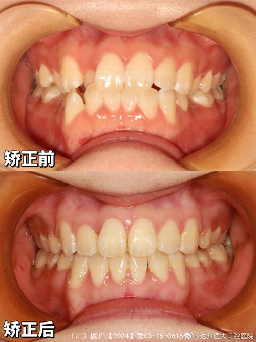 矫正牙齿和美白牙齿，先做哪个更合适？-图1
