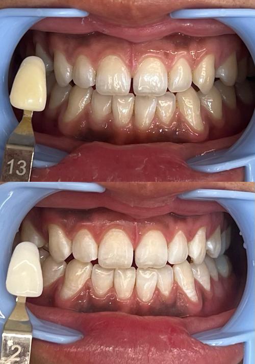 矫正牙齿和美白牙齿，先做哪个更合适？-图3