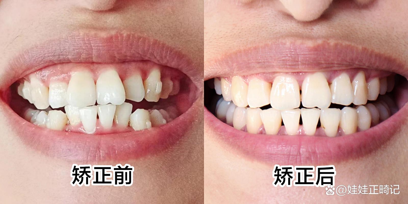 矫正牙齿和美白牙齿，先做哪个更合适？-图2