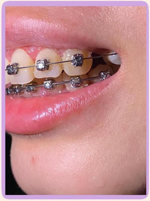 牙齿矫正 成人-图2
