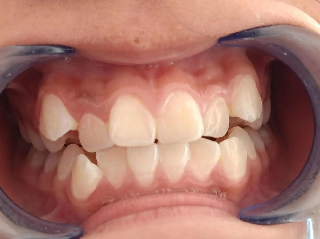 牙齿矫正牙齿不贴合，是什么原因导致的？该如何解决？-图1