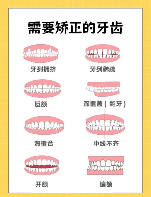 矫正牙齿要怎么矫正-图1 矫正牙齿要怎么矫正-图1