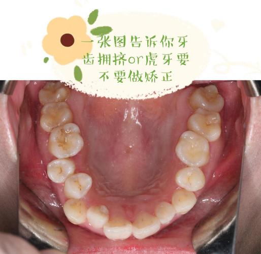虎牙不矫正，真的不用管吗？-图2