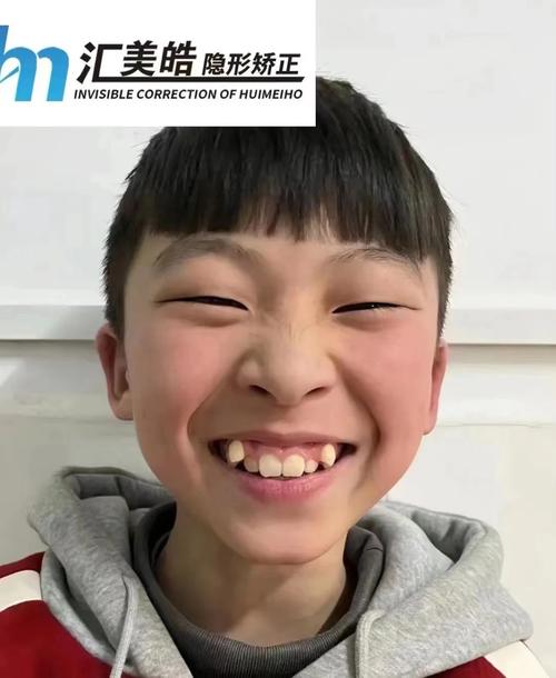 虎牙不矫正，真的不用管吗？-图3