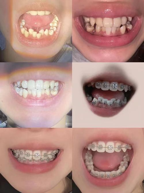 牙齿矫正前后效果图效果如何?变化大不大?-图1 牙齿矫正前后效果图效果如何?变化大不大?-图1