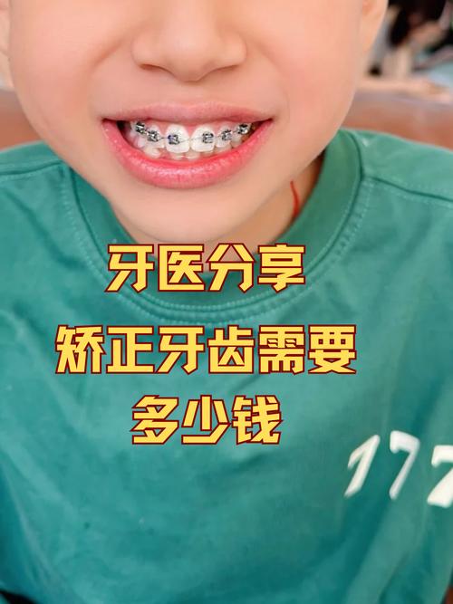 三颗牙齿矫正费用多少?价格受哪些因素影响?-图3 三颗牙齿矫正费用多少?价格受哪些因素影响?-图3