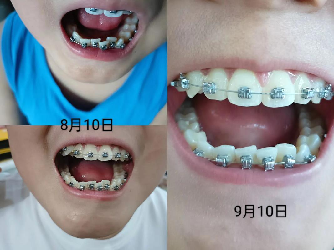 牙齿矫正第一次复诊要注意啥?流程和感受是怎样的?-图1 牙齿矫正第一次复诊要注意啥?流程和感受是怎样的?-图1