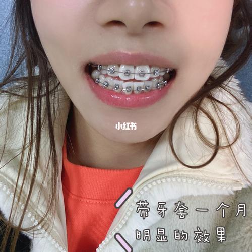 牙齿矫正第一次复诊要注意啥?流程和感受是怎样的?-图3 牙齿矫正第一次复诊要注意啥?流程和感受是怎样的?-图3