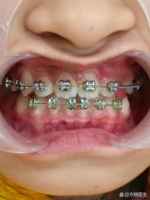 牙齿矫正器刚带很痛-图1