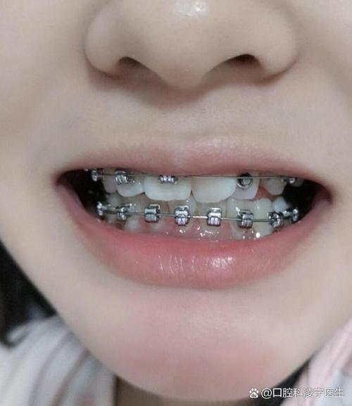 牙齿矫正器刚带很痛-图3
