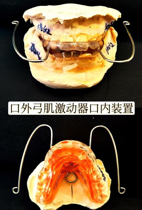 牙齿矫正器怎么选？哪种类型更适合自己？-图1