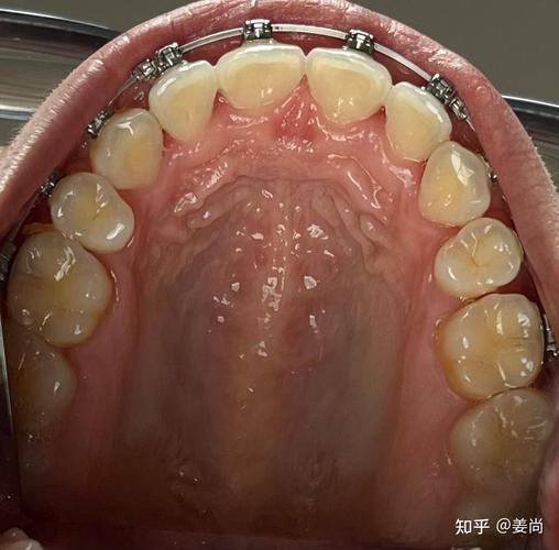 四川省医院矫正牙齿效果如何？价格贵不贵？医生靠谱吗？-图1