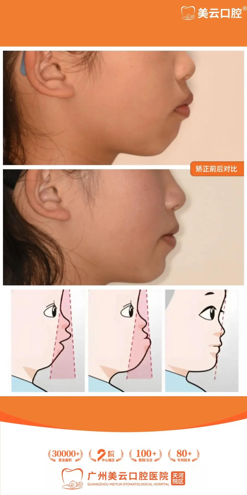 牙齿矫正三年后变形，是矫正失败还是护理不到位？-图1