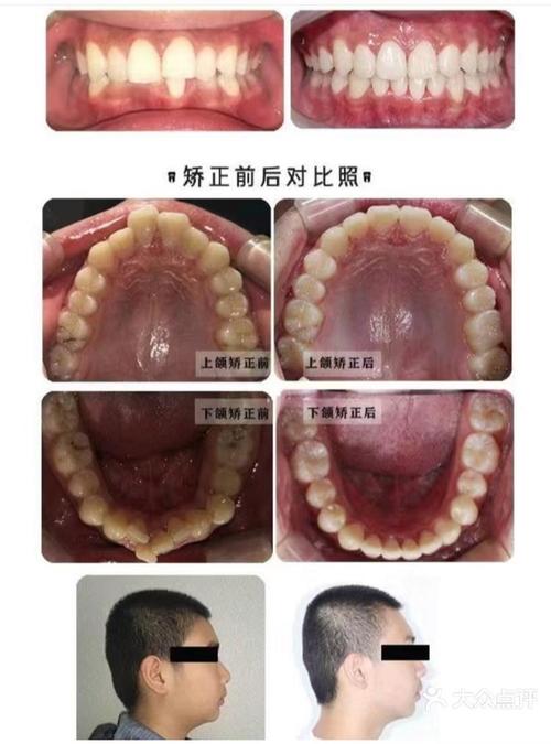 牙齿矫正三年后变形，是矫正失败还是护理不到位？-图2