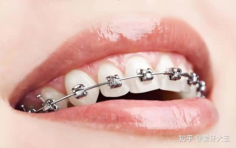 牙齿矫正打骨钉要花多少钱？-图1