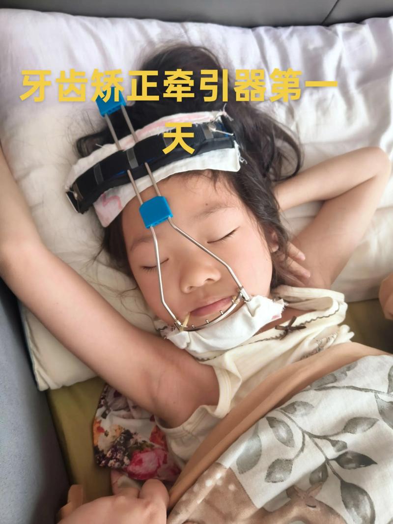 小孩牙齿矫正好不好?家长必知的利弊与注意事项-图1 小孩牙齿矫正好不好?家长必知的利弊与注意事项-图1