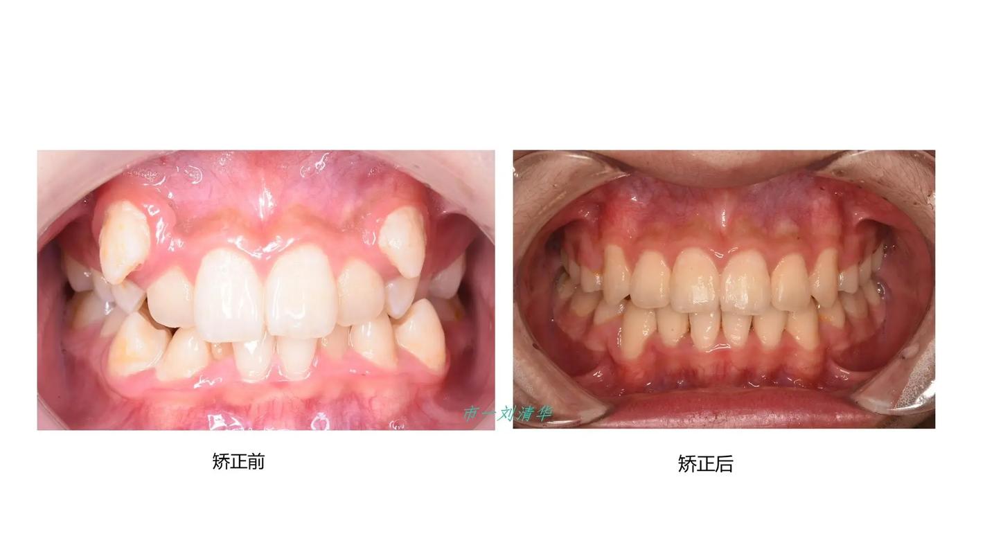 没拔牙矫正牙齿拥挤？效果与方法是否可行？-图3
