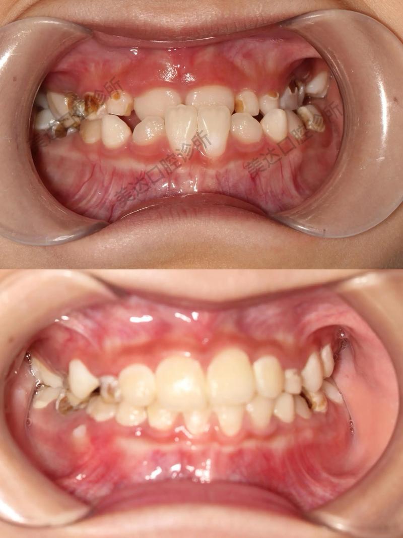 哪些牙齿矫正难度大？原因有哪些？-图2