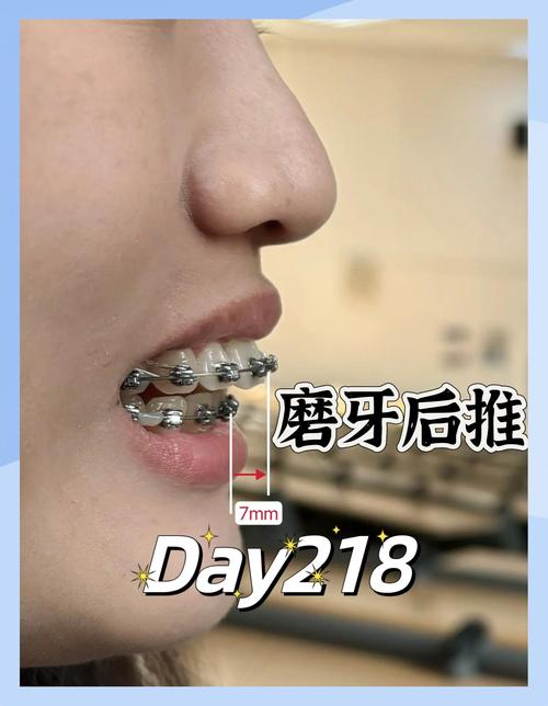 矫正牙齿戴推簧好疼,是正常现象吗?咋缓解呀?-图1 矫正牙齿戴推簧好疼,是正常现象吗?咋缓解呀?-图1