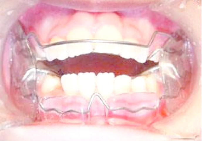 矫正牙齿戴推簧好疼,是正常现象吗?咋缓解呀?-图3 矫正牙齿戴推簧好疼,是正常现象吗?咋缓解呀?-图3