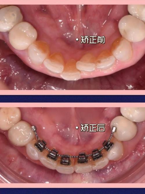 成年人牙齿舌侧矫正，效果如何？适合哪些人群？-图1