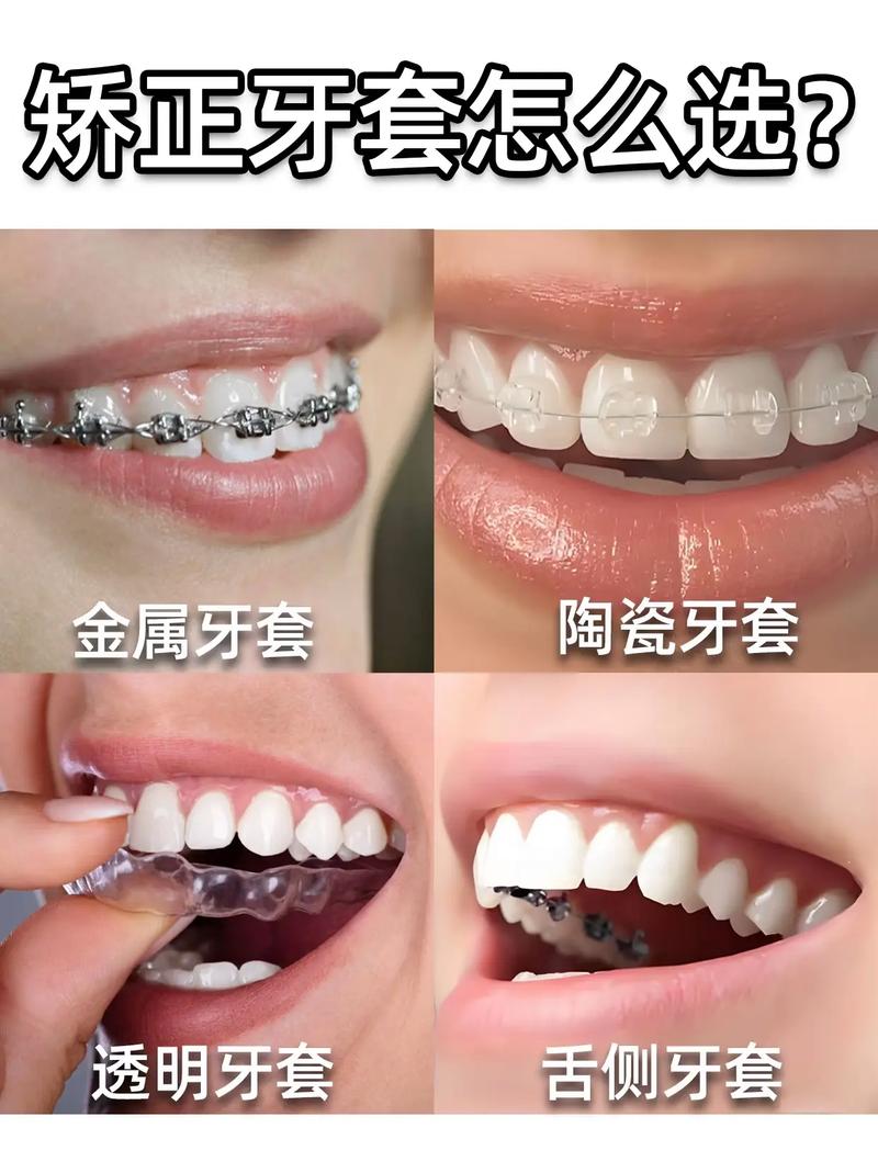 牙齿矫正必须戴牙套吗？还有其他矫正方式可选？-图2