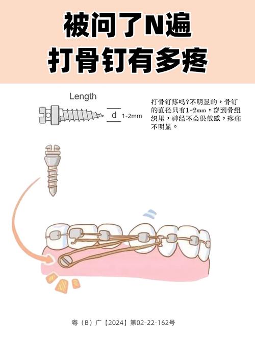 矫正打骨钉疼不疼?牙齿矫正骨钉植入痛感如何?-图1 矫正打骨钉疼不疼?牙齿矫正骨钉植入痛感如何?-图1