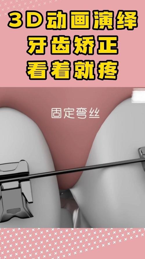 矫正牙齿过程疼吗？疼痛程度如何？-图3