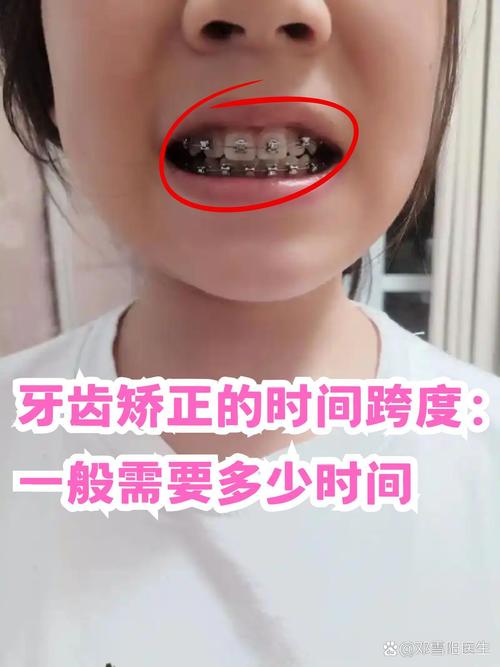 矫正牙齿多久弄一次-图3