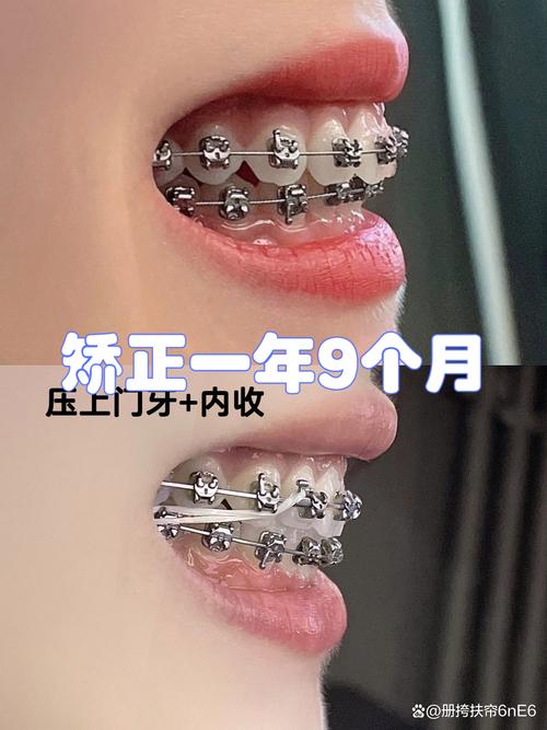 矫正拔牙必看！到底该拔哪颗牙？-图3