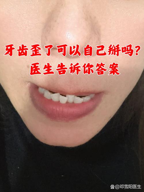 牙齿太歪了影响咀嚼和美观,能矫正吗?-图3 牙齿太歪了影响咀嚼和美观,能矫正吗?-图3