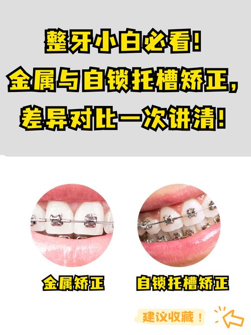 牙齿矫正器是怎么固定在牙齿上的呢?-图1 牙齿矫正器是怎么固定在牙齿上的呢?-图1