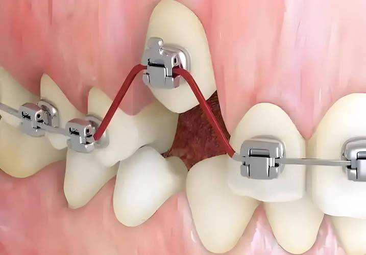 牙齿矫正最新技术有哪些突破与应用？-图1