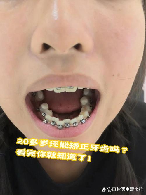 不用戴牙套矫正牙齿?这种不戴牙套的方法真的有效吗?-图2 不用戴牙套矫正牙齿?这种不戴牙套的方法真的有效吗?-图2
