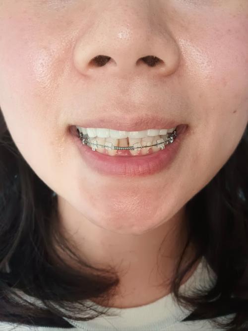 什么是半口矫正牙齿-图2