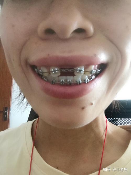 矫正牙齿拔门牙是必须的吗?会有哪些影响?-图3 矫正牙齿拔门牙是必须的吗?会有哪些影响?-图3