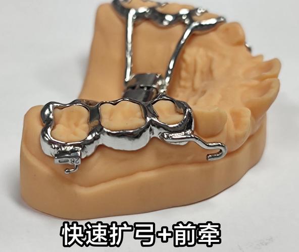 牙齿矫正扩弓是什么？扩弓矫正的原理与作用？-图1