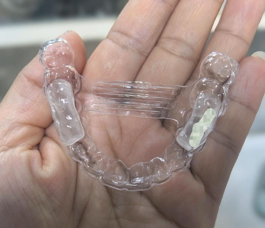 牙套矫正牙齿真的有效吗?效果和安全性如何?-图1 牙套矫正牙齿真的有效吗?效果和安全性如何?-图1