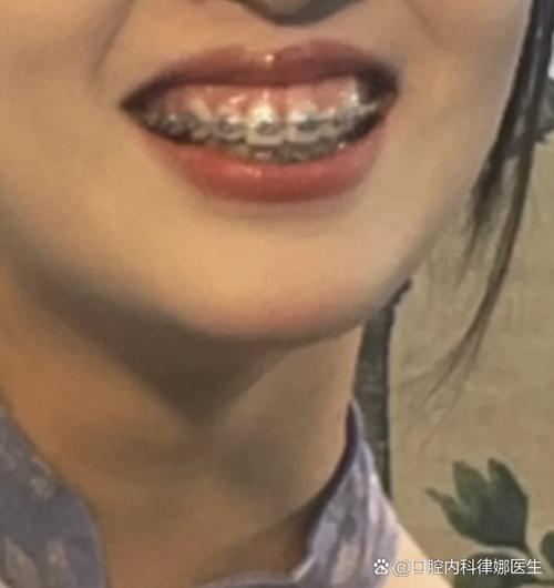 牙齿矫正后牙龈外露，是什么原因导致的牙龈外露现象？-图2