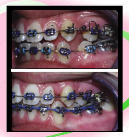 为什么矫正牙齿要戴小弹簧?它到底有什么作用?-图2 为什么矫正牙齿要戴小弹簧?它到底有什么作用?-图2