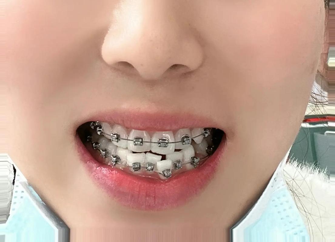 拔8颗牙齿矫正脸型？真的有必要且安全吗？-图3