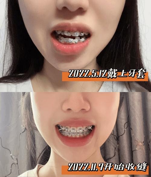 矫正牙齿半年变化图效果能有多惊艳？-图1