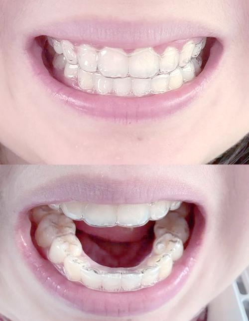 矫正过后的牙齿图片-图1