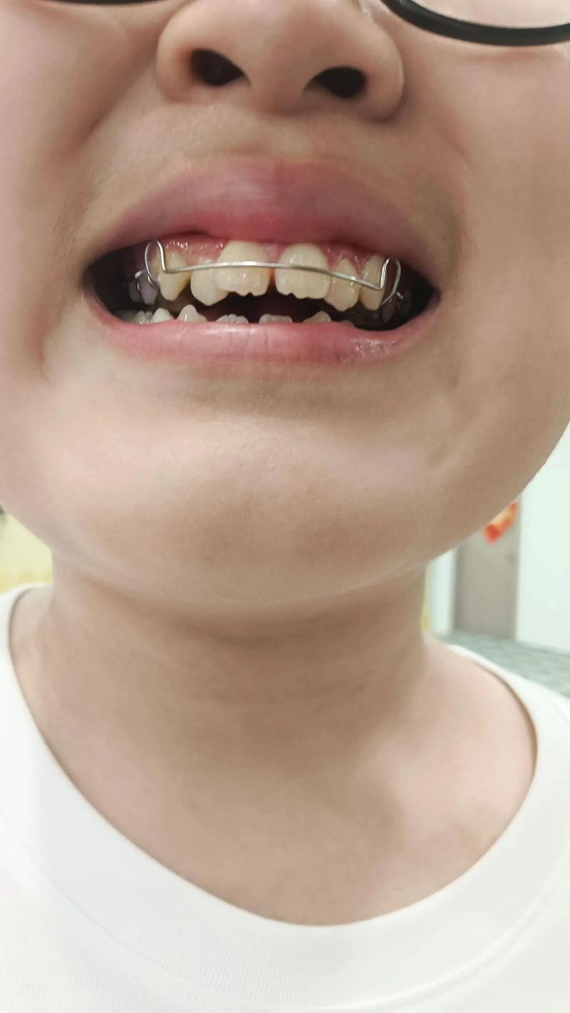 矫正过后的牙齿图片-图3