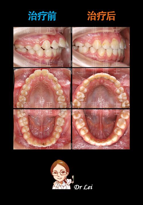 牙齿矫正下巴的变化-图1