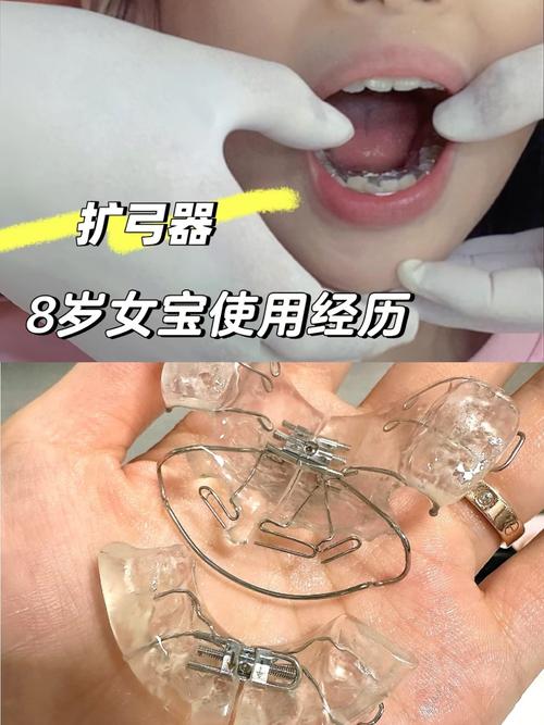 儿童牙齿早期矫正器，何时戴效果最好？越早干预越好吗？-图1