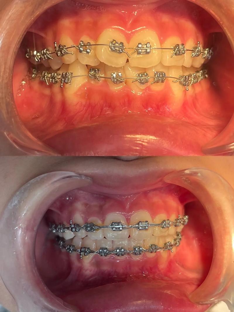 手术矫正牙齿怎么样-图2